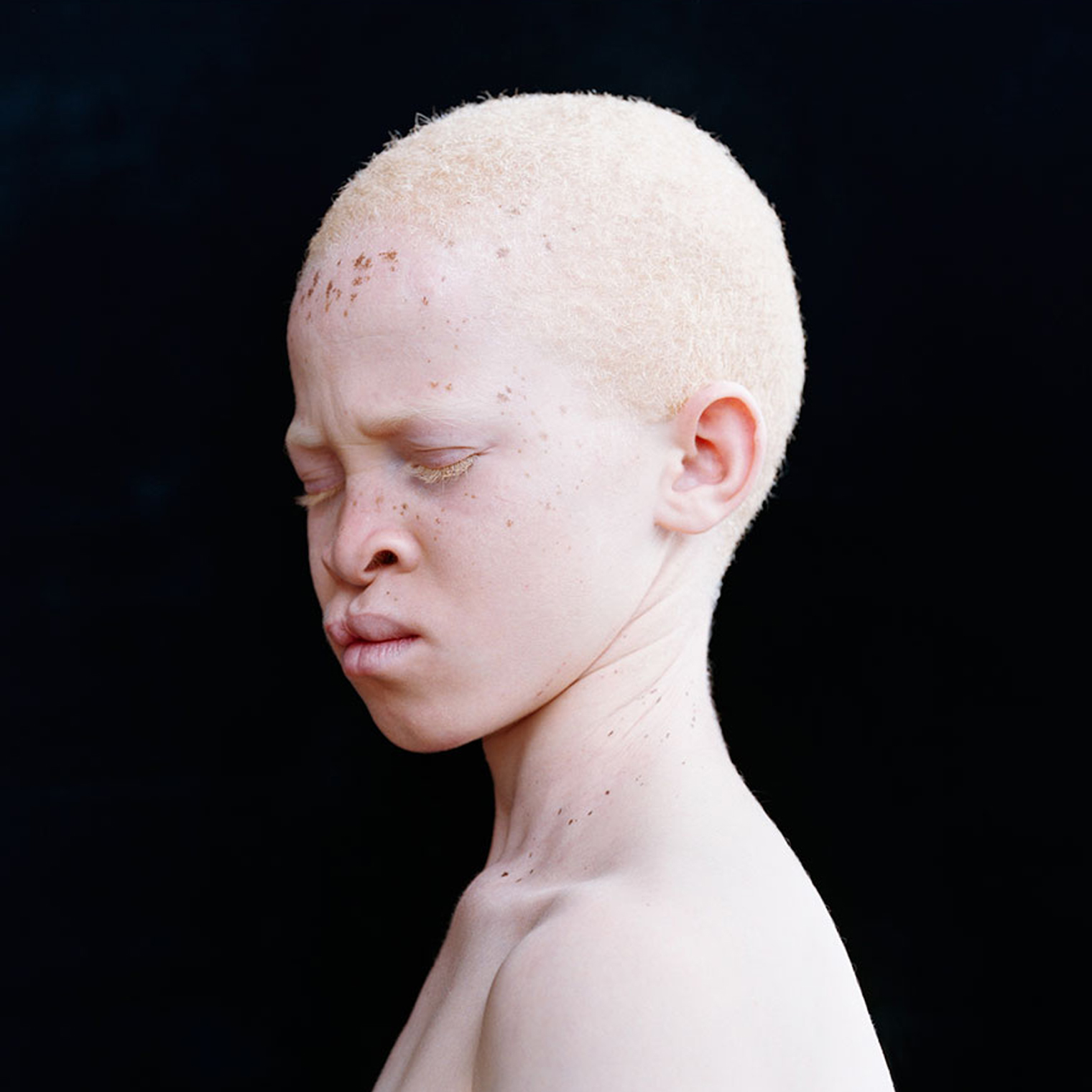 Альбинизмом страдают. Тотальный альбинизм. Наследственная болезнь альбинизм. Генные болезни альбинизм.