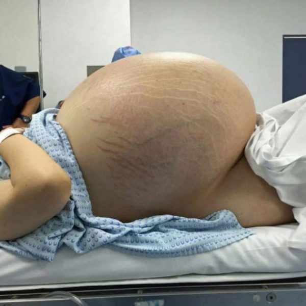cisto gigante 01