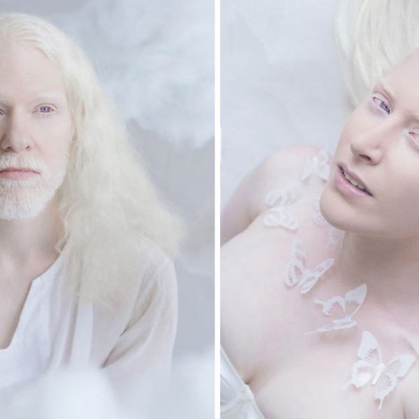 albinos