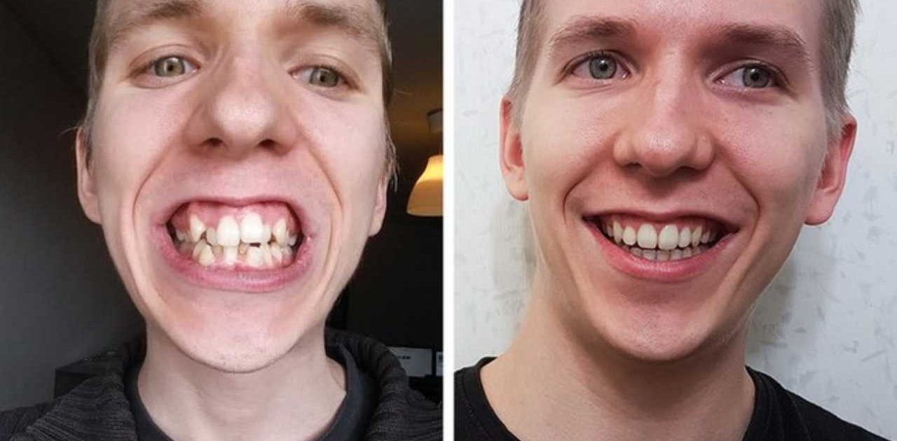 aparelho nos dentes capa