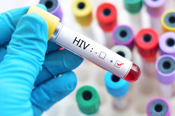 Blood sample positive with HIV ; Shutterstock ID 730137559