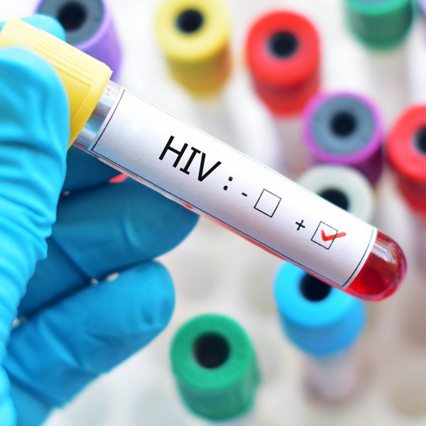 Blood sample positive with HIV ; Shutterstock ID 730137559