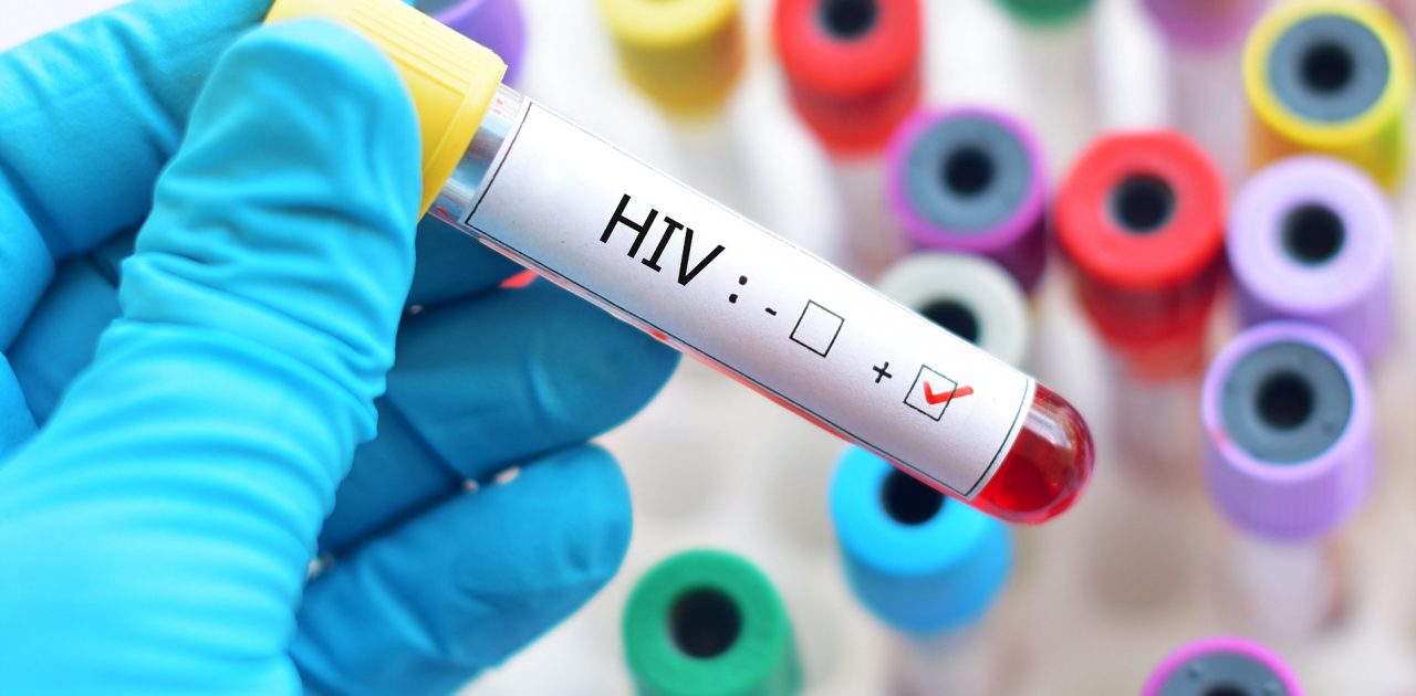 Blood sample positive with HIV ; Shutterstock ID 730137559