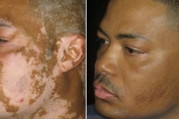 vitiligo capa