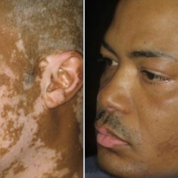 vitiligo capa