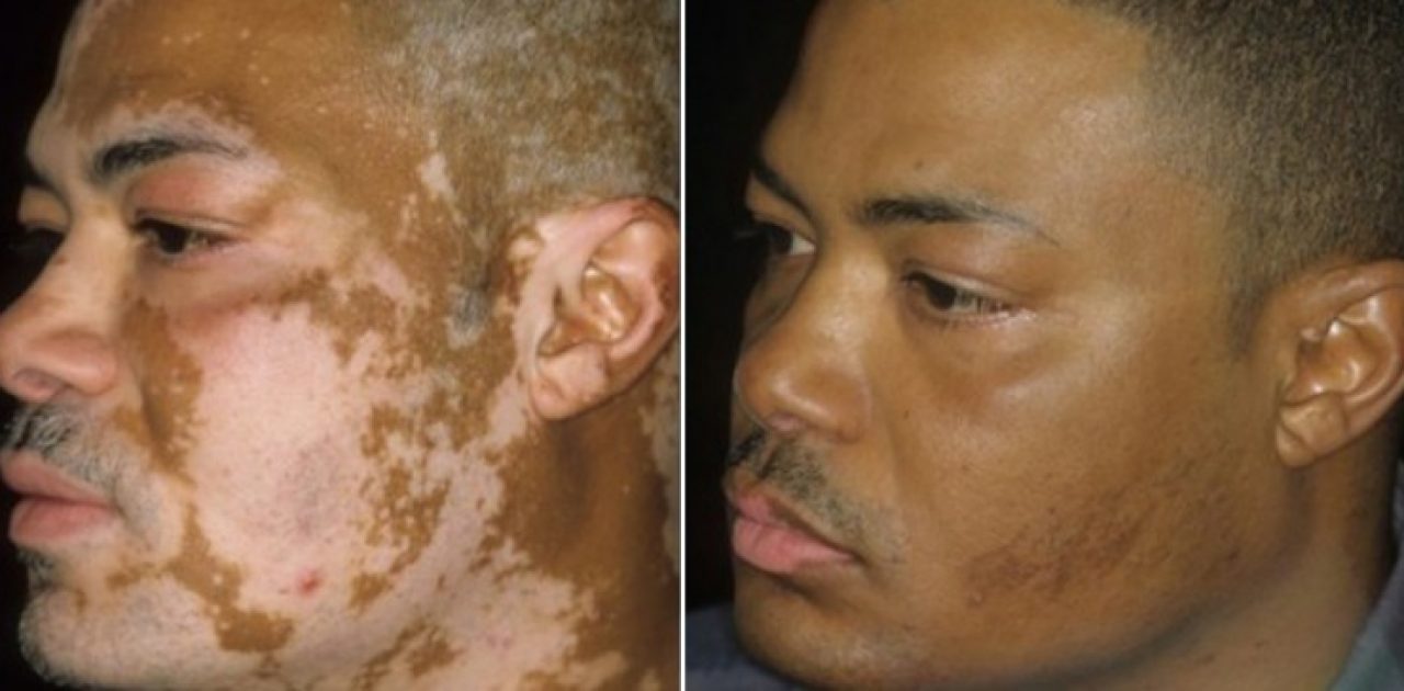 vitiligo capa